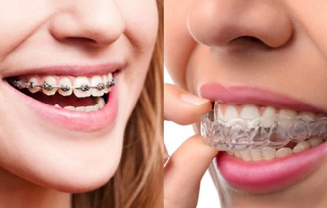 Invisalign vs braces