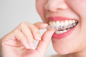 Invisalign Attachments