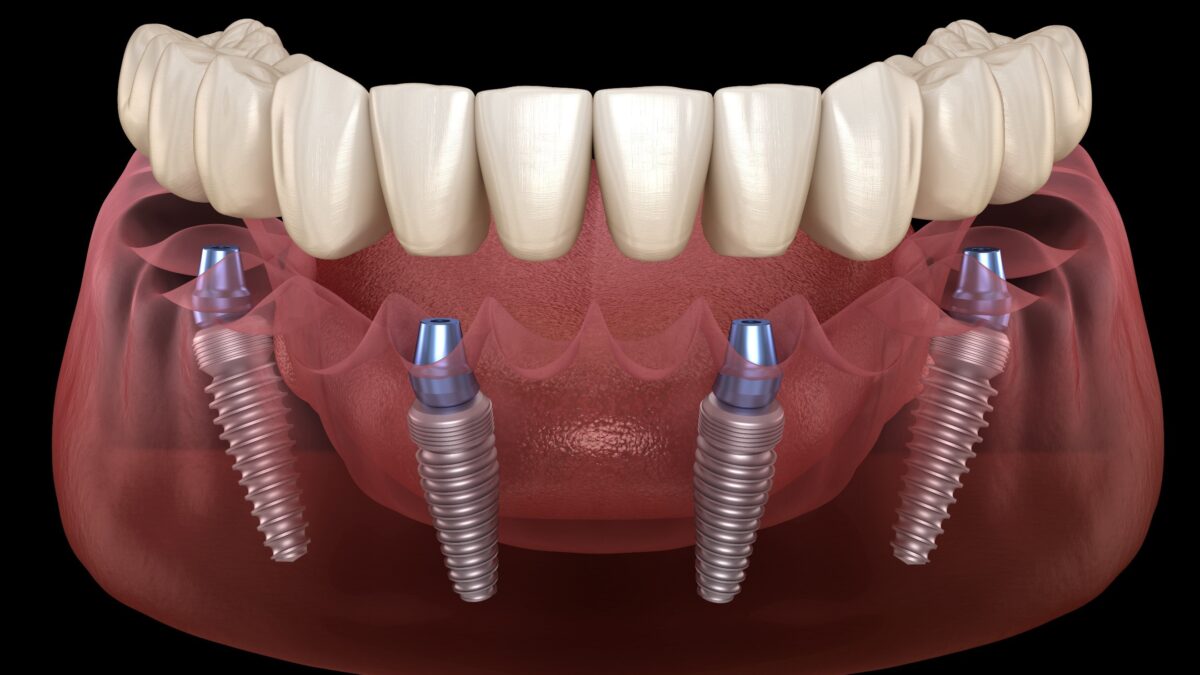 All On Four dental implants